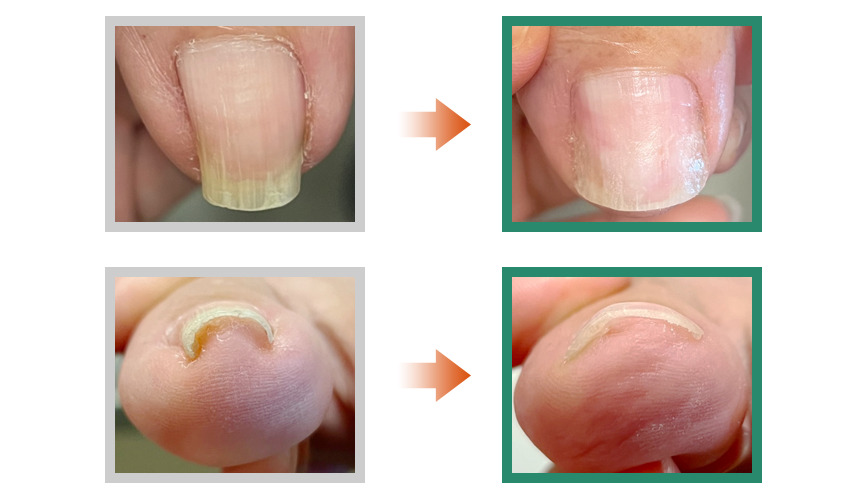 巻き爪フットケア目黒院,目黒 巻き爪,目黒 陥入爪