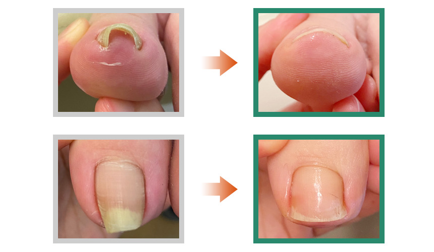 巻き爪フットケア目黒院,目黒 巻き爪,目黒 陥入爪