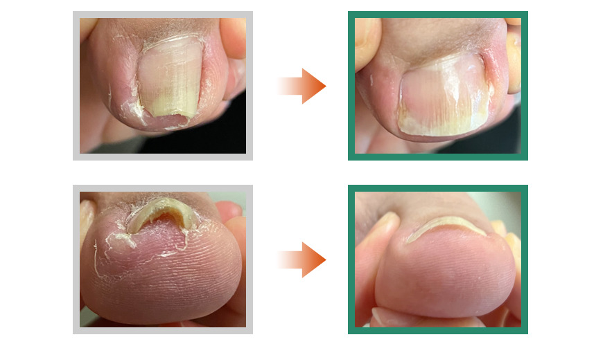 巻き爪フットケア目黒院,目黒 巻き爪,目黒 陥入爪