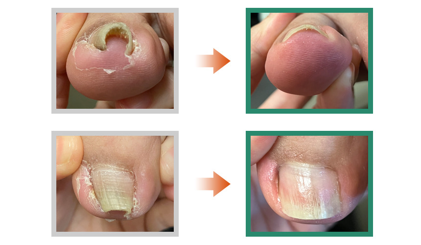 巻き爪フットケア目黒院,目黒 巻き爪,目黒 陥入爪